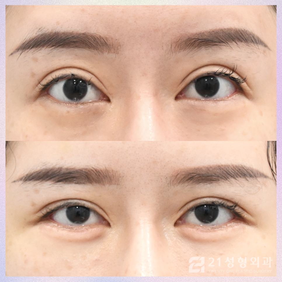 강남눈밑지방재배치잘하는곳 다른 차이는 관련 이미지 1