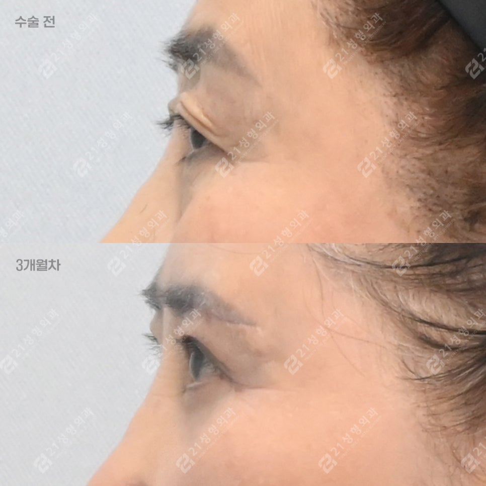 If You Keep Tensing Your Forehead, Consider Eyelid Drooping image 3