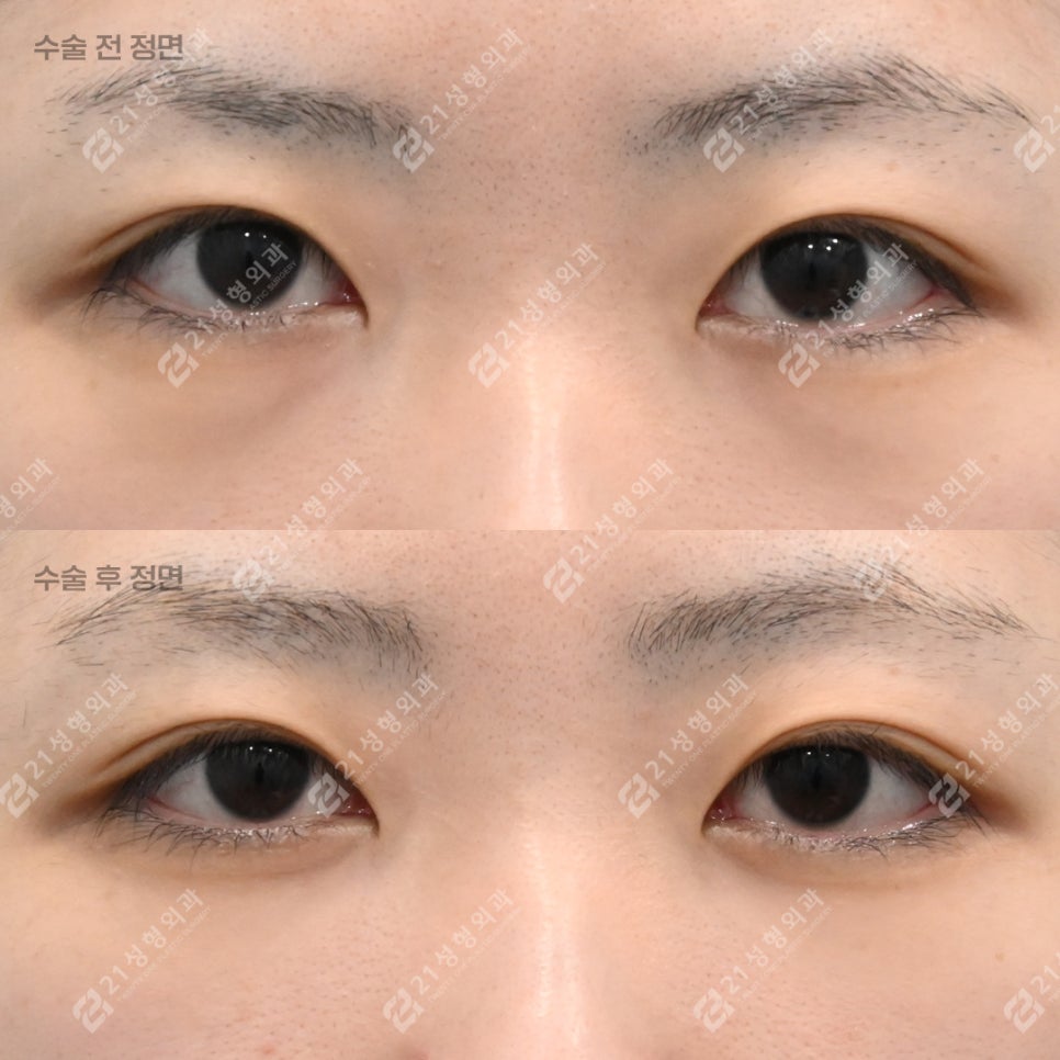 Will Under-Eye Fat Repositioning Improve the Appearance of a Tired-Looking Face? image 1