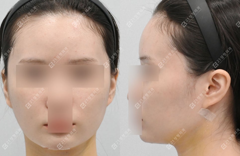 The Reason a Double Chin Appeared After Surgery Was Not a Fat Problem image 3