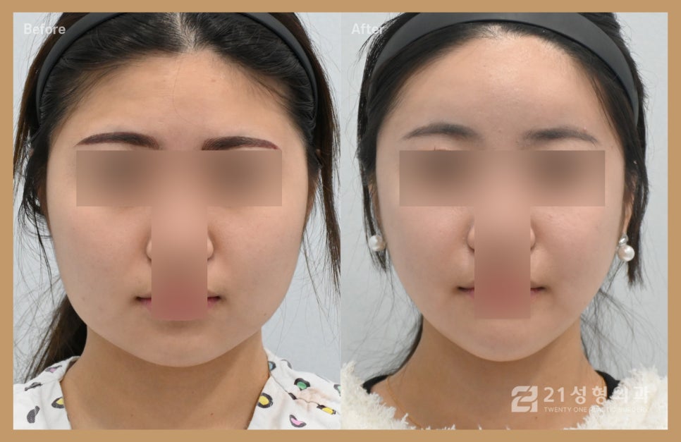 사각턱성형 부작용 없이 이득 보는 비결 관련 이미지 1
