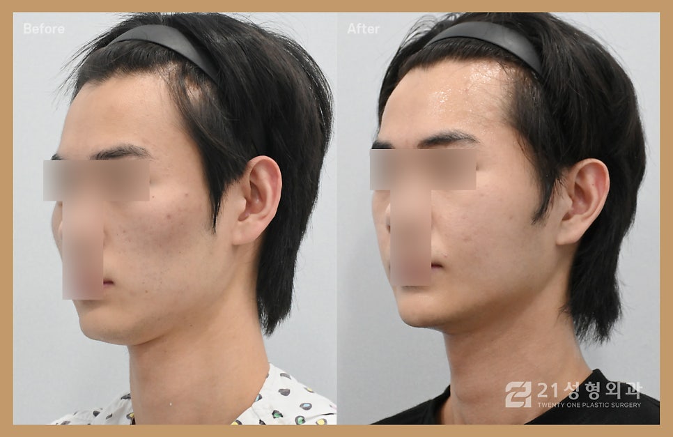 남자광대축소술 울퉁불퉁한 라인을 매끄럽게 관련 이미지 2