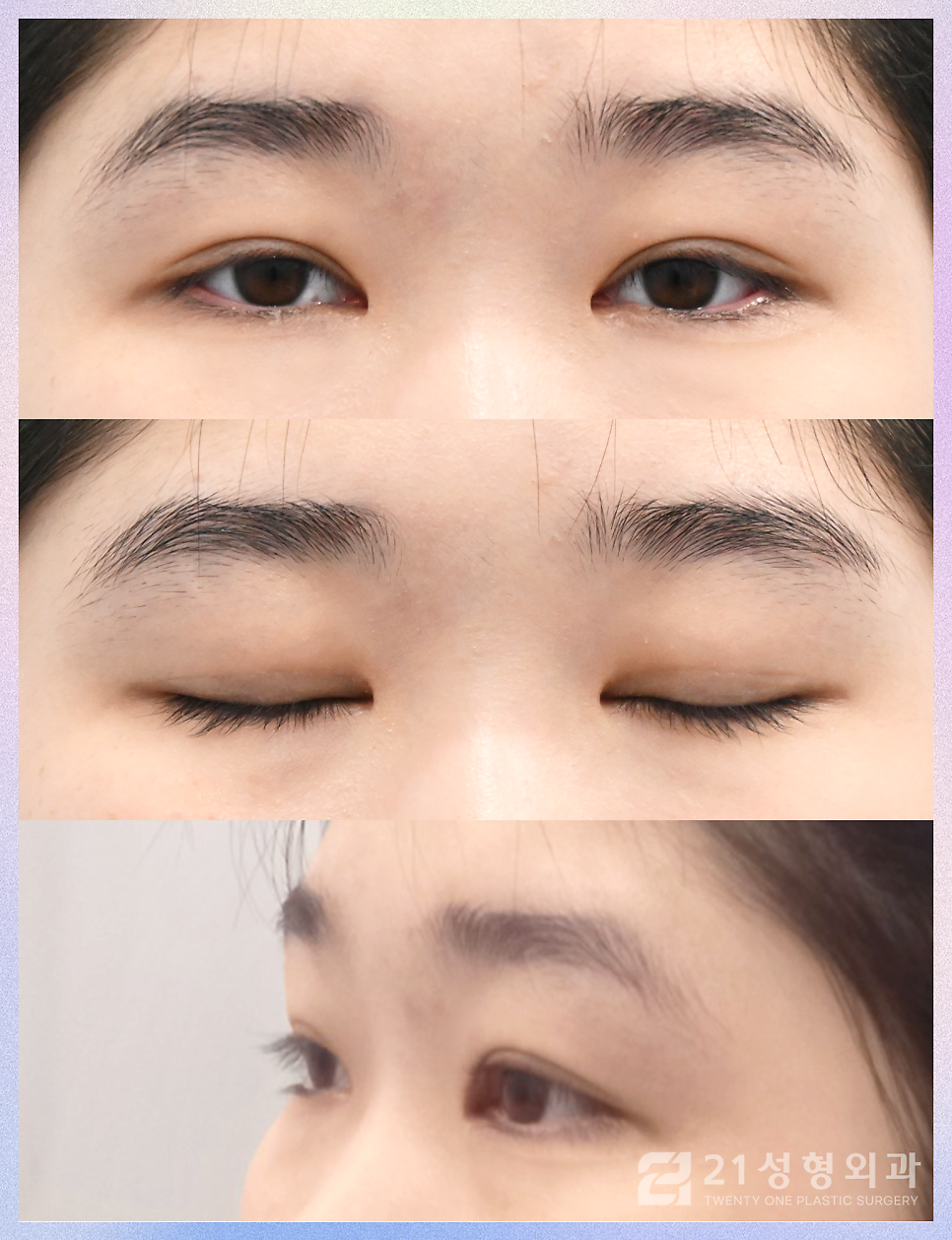 쌍꺼풀절개수술 안검하수를 효과적으로 개선하는 방법 관련 이미지 6