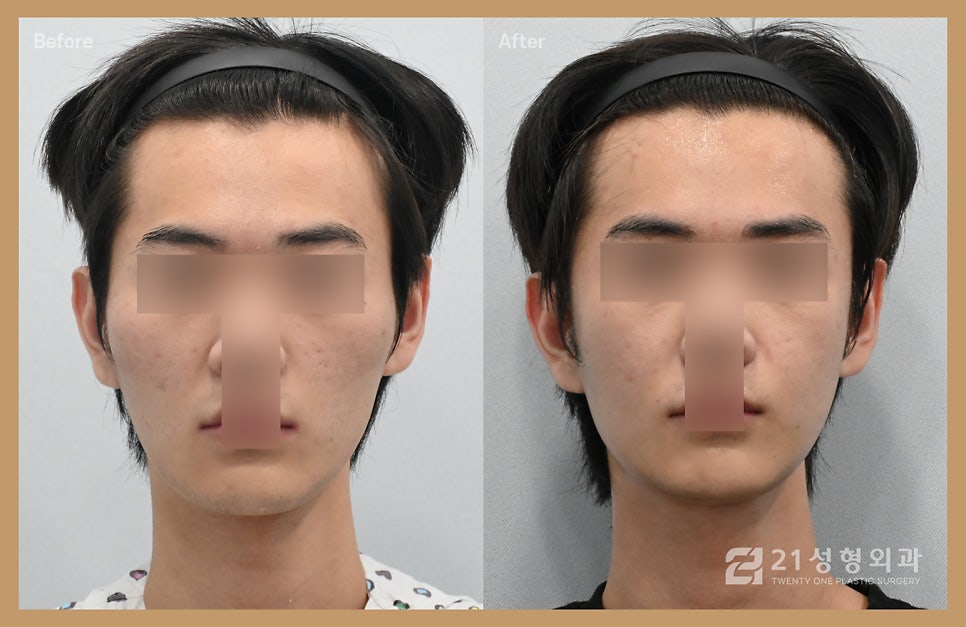 남자광대축소술 울퉁불퉁한 라인을 매끄럽게 관련 이미지 1