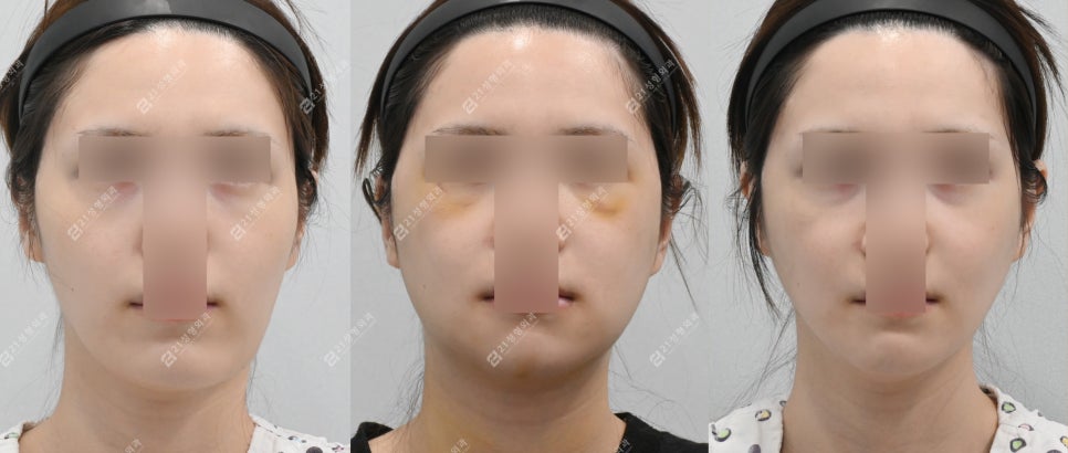 안면비대칭 개선된 윤곽수술전후 케이스 관련 이미지 6