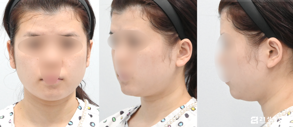 안면윤곽 3종 케이스에 따라 다른 수술과정 관련 이미지 5