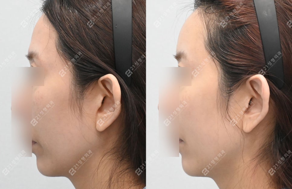 Could a lump you feel after fat grafting be cancer? image 1