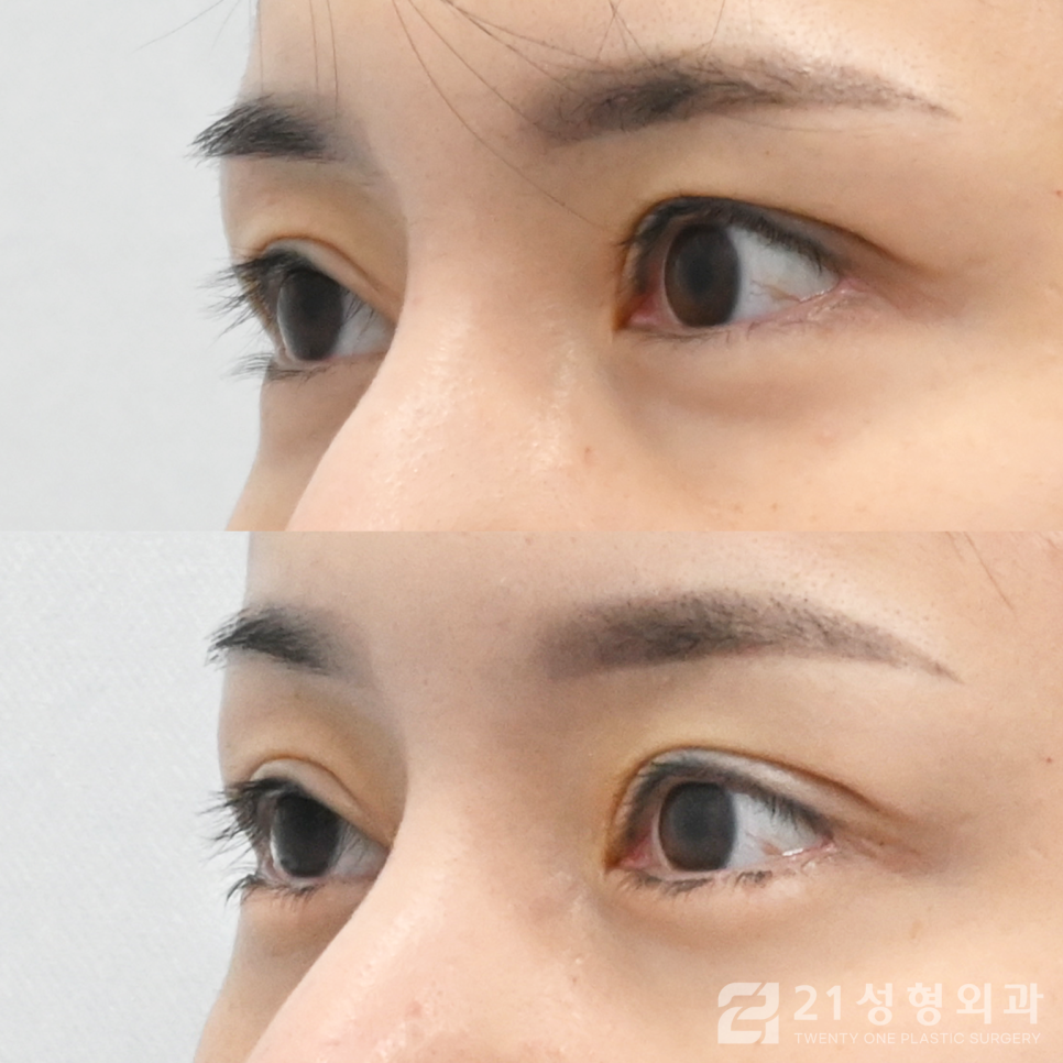 눈밑지방재배치수술병원 확실한 효과는 관련 이미지 2