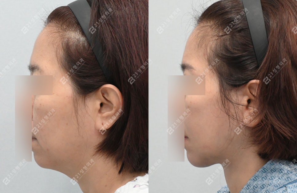 거상 수술의 효과를 극대화하는 방법, 안면목거상 + 근육묶기 케이스 관련 이미지 7