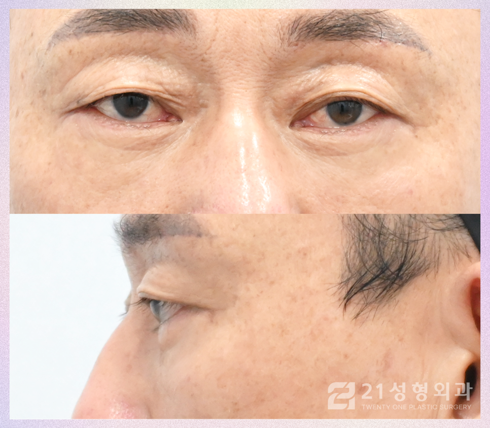 중년눈수술, 젊어지기 위해 필요한 것은 이것입니다 관련 이미지 6