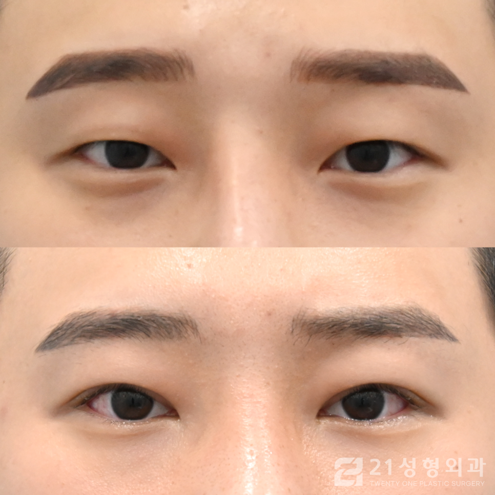 첫눈성형잘하는곳 아름다워지는 지름길 관련 이미지 1