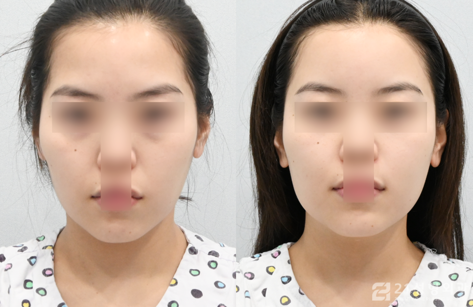 얼굴지방이식잘하는곳 실패 없이 찾는 방법 관련 이미지 1