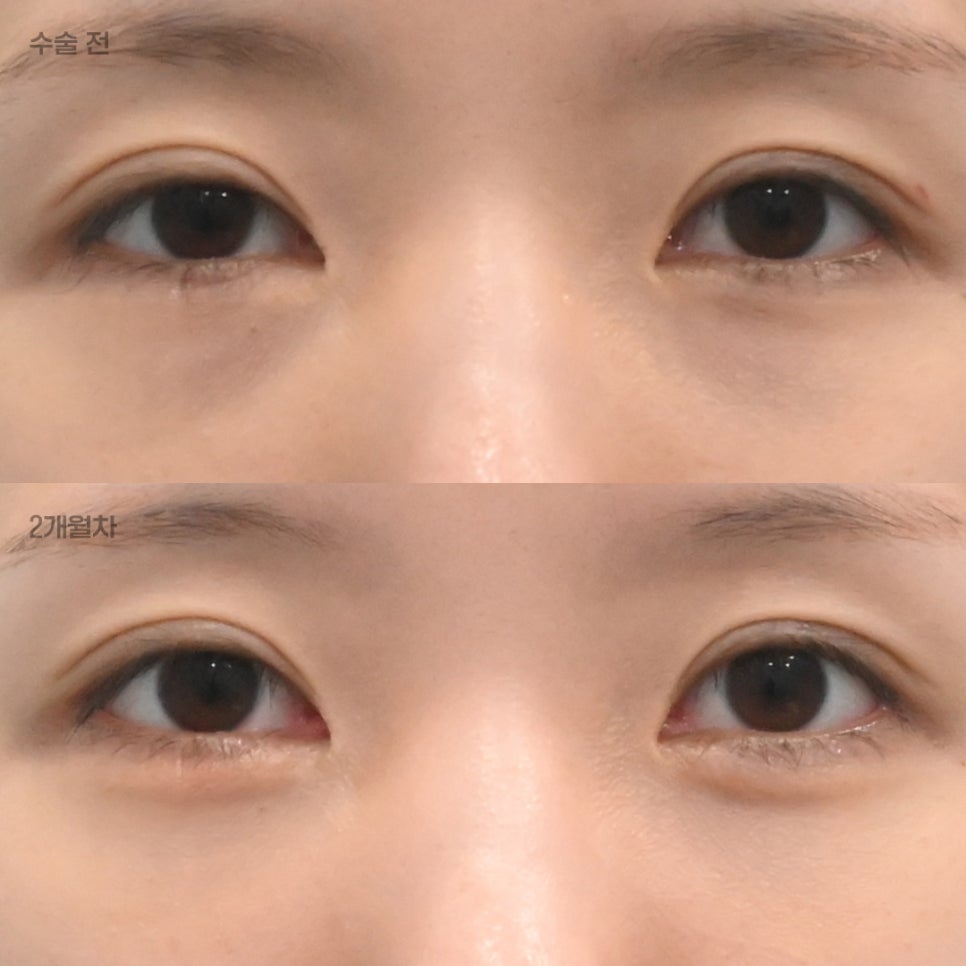 눈밑지방재배치 후 피&middot;눈물&middot;멍&middot;부기 과연 괜찮은 걸까? 관련 이미지 1