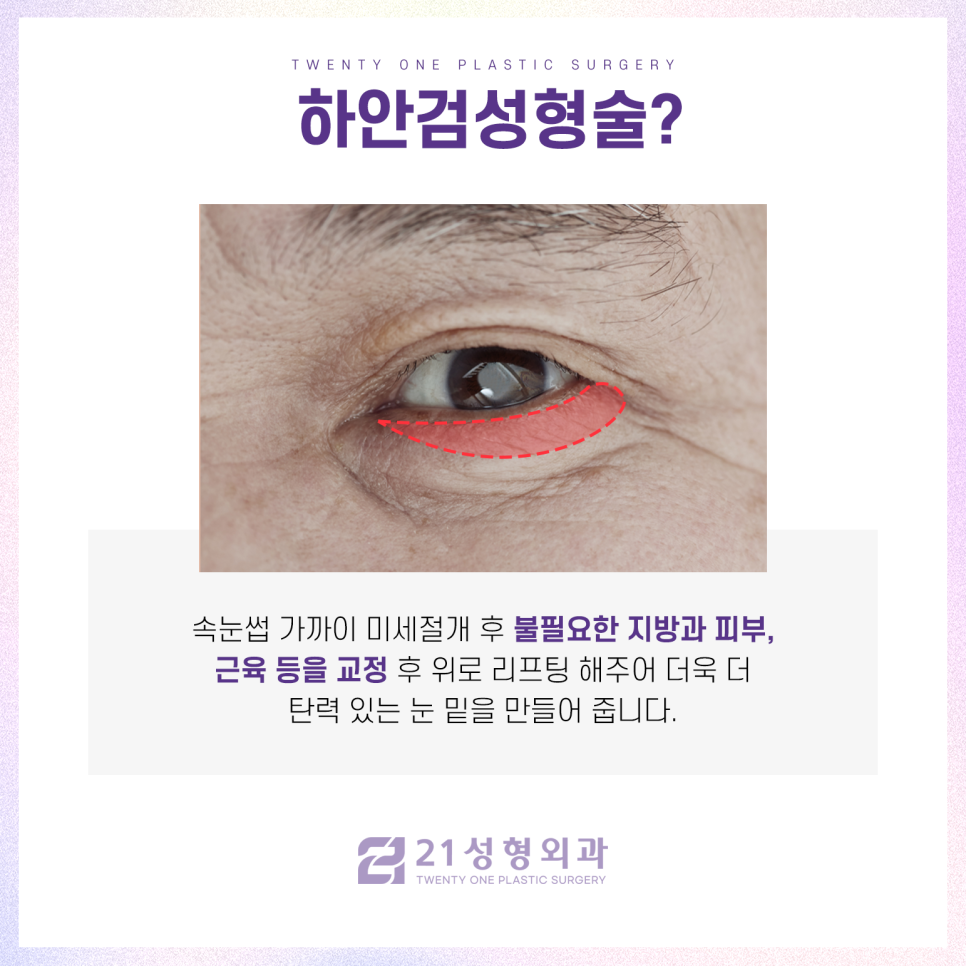 중년눈수술, 젊어지기 위해 필요한 것은 이것입니다 관련 이미지 3