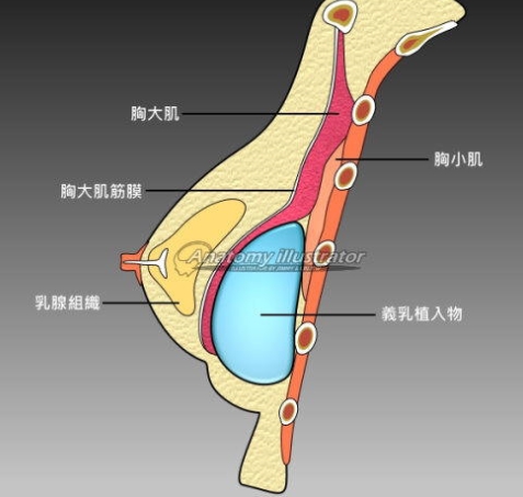 관상형 유방 (Tubular breast) 관련 이미지 7