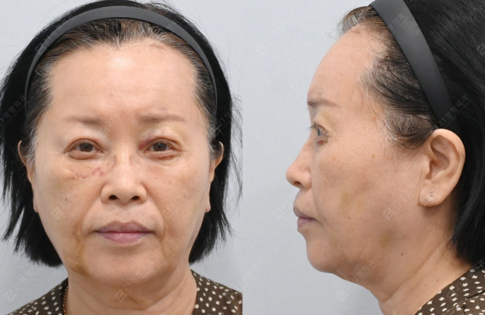 자연스럽게 젊어지고 싶다면? 중년 수술 이마거상, 상.하안검으로 해결! 관련 이미지 4