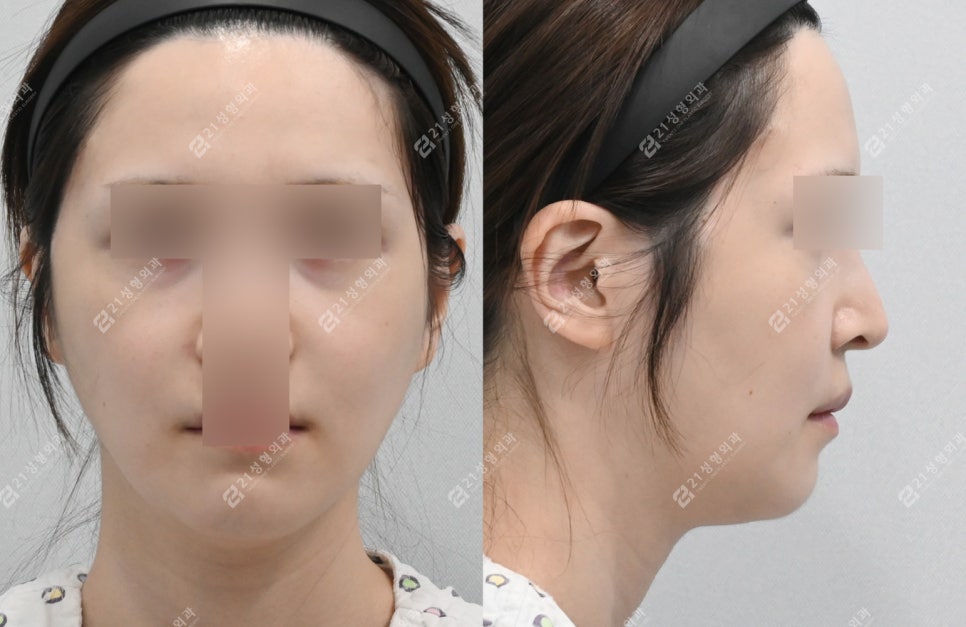 안면비대칭 개선된 윤곽수술전후 케이스 관련 이미지 5