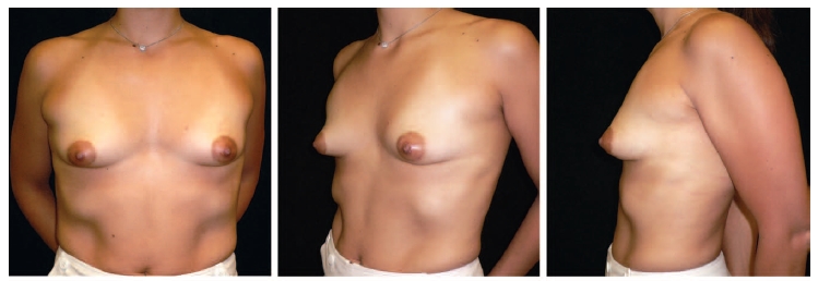 관상형 유방 (Tubular breast) 관련 이미지 4