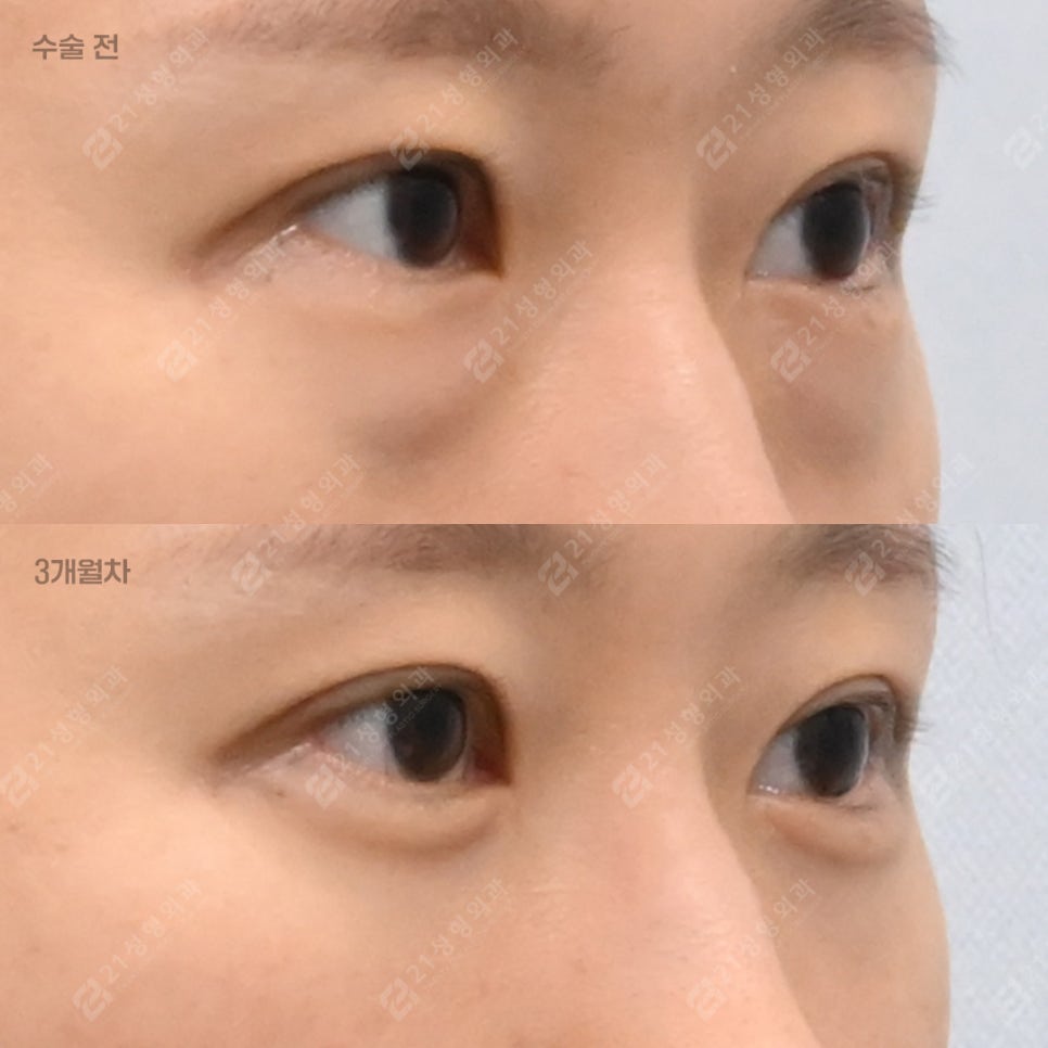 With Lower-Eyelid Fat Repositioning and Fat Grafting: The Real Reason Your Eyes Look Different image 2