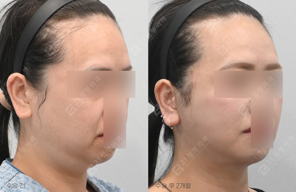 Why Does My Face Still Look the Same Even After Having Many Lifting Procedures? image 2