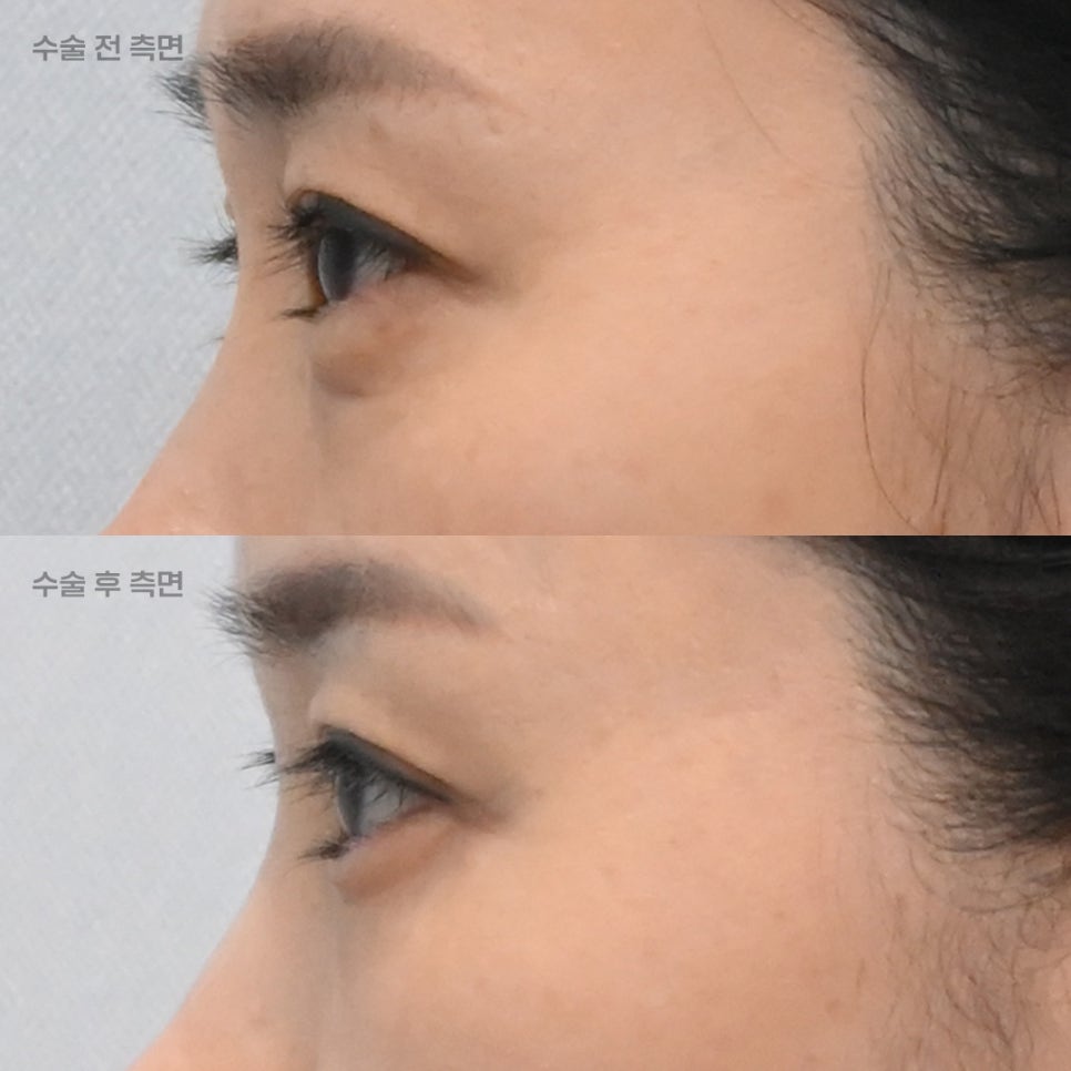 상담할 때 눈밑 피부를 먼저 확인하는 이유 관련 이미지 3