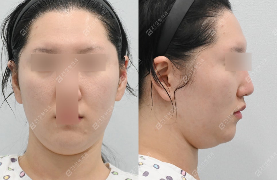 얼굴지방흡입붓기 2개월차 전후경과 관련 이미지 1