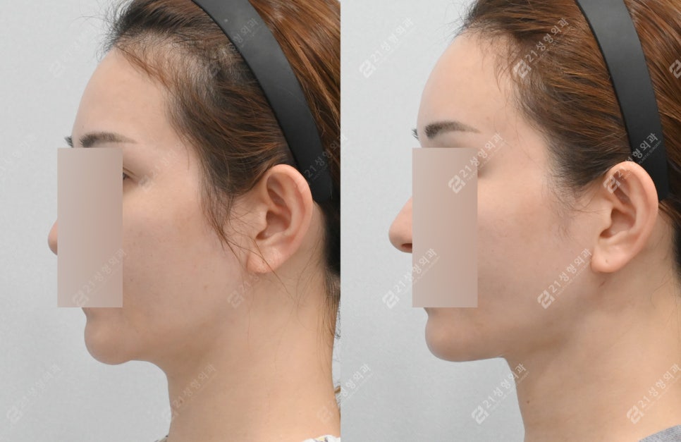 이중턱 수술과 마녀턱교정 한 번에 가능한가요? 관련 이미지 1