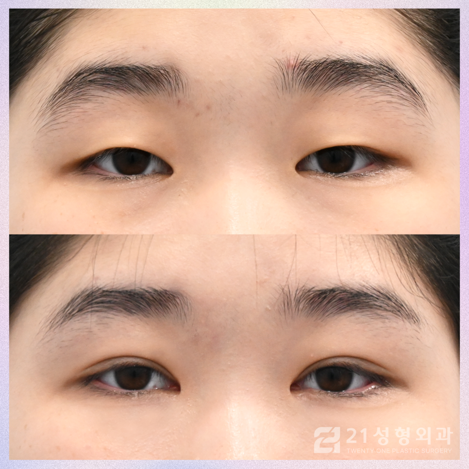 쌍꺼풀절개수술 안검하수를 효과적으로 개선하는 방법 관련 이미지 1