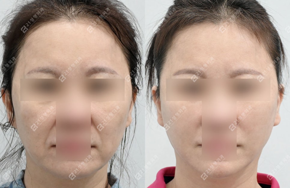 A Face That Needed a Lift, Not a Thread Lift — and There Was a Reason image 5