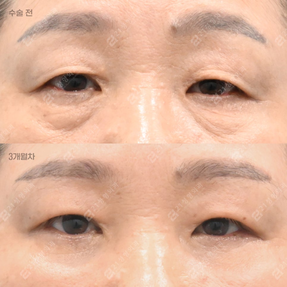 Do Your Eyes Feel Heavy and Constricted? 21 Plastic Surgery Explains How to Self-Assess for a Sub-Brow Lift image 1