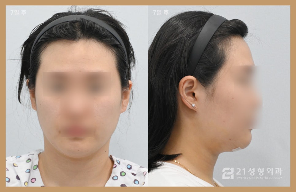이중턱지방흡입부기 과정이 궁금하다면 관련 이미지 4