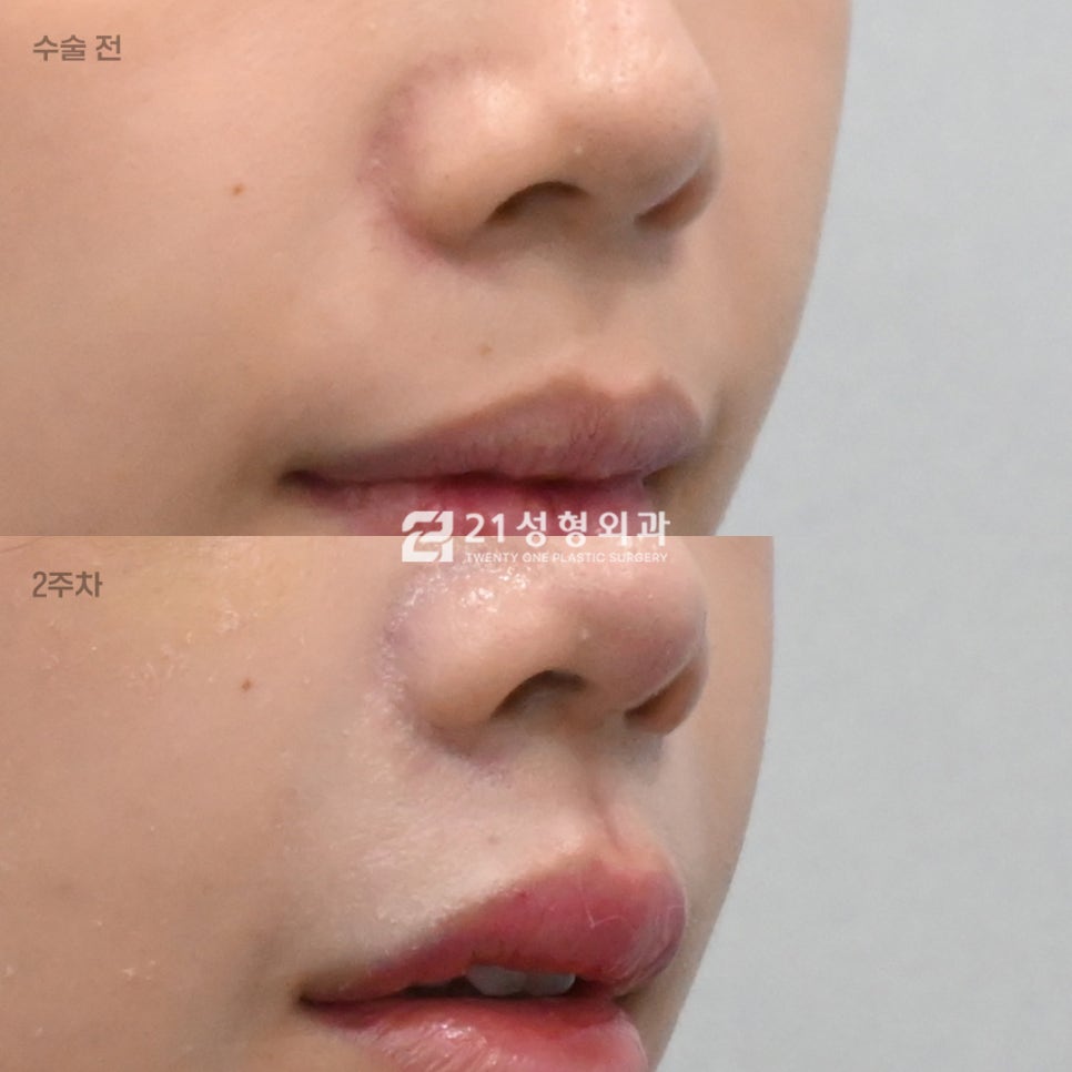 인중 흉터 없이 짧아 보이는 법? 성형외과 원장이 밝히는 인중 라인 착시 효과 관련 이미지 2