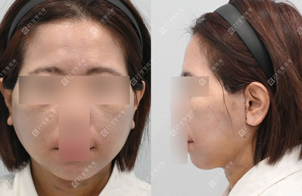 거상 수술의 효과를 극대화하는 방법, 안면목거상 + 근육묶기 케이스 관련 이미지 4