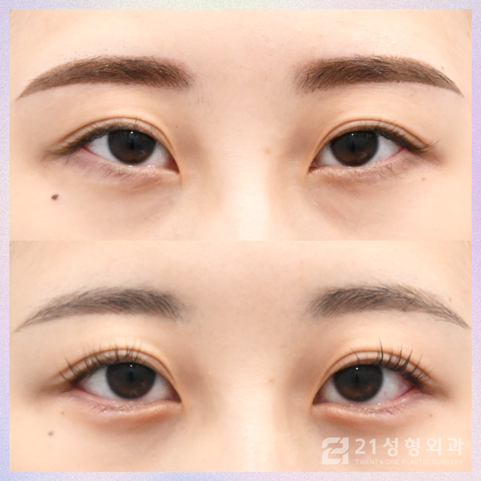눈트임성형으로 크고 선명하게 관련 이미지 1