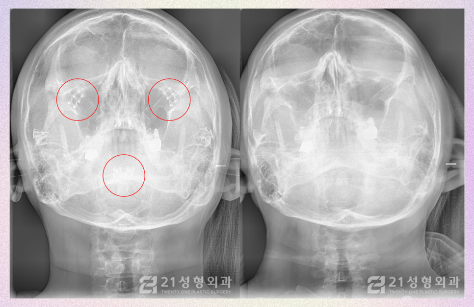 강남안면윤곽핀제거 수술 시기는? 관련 이미지 2