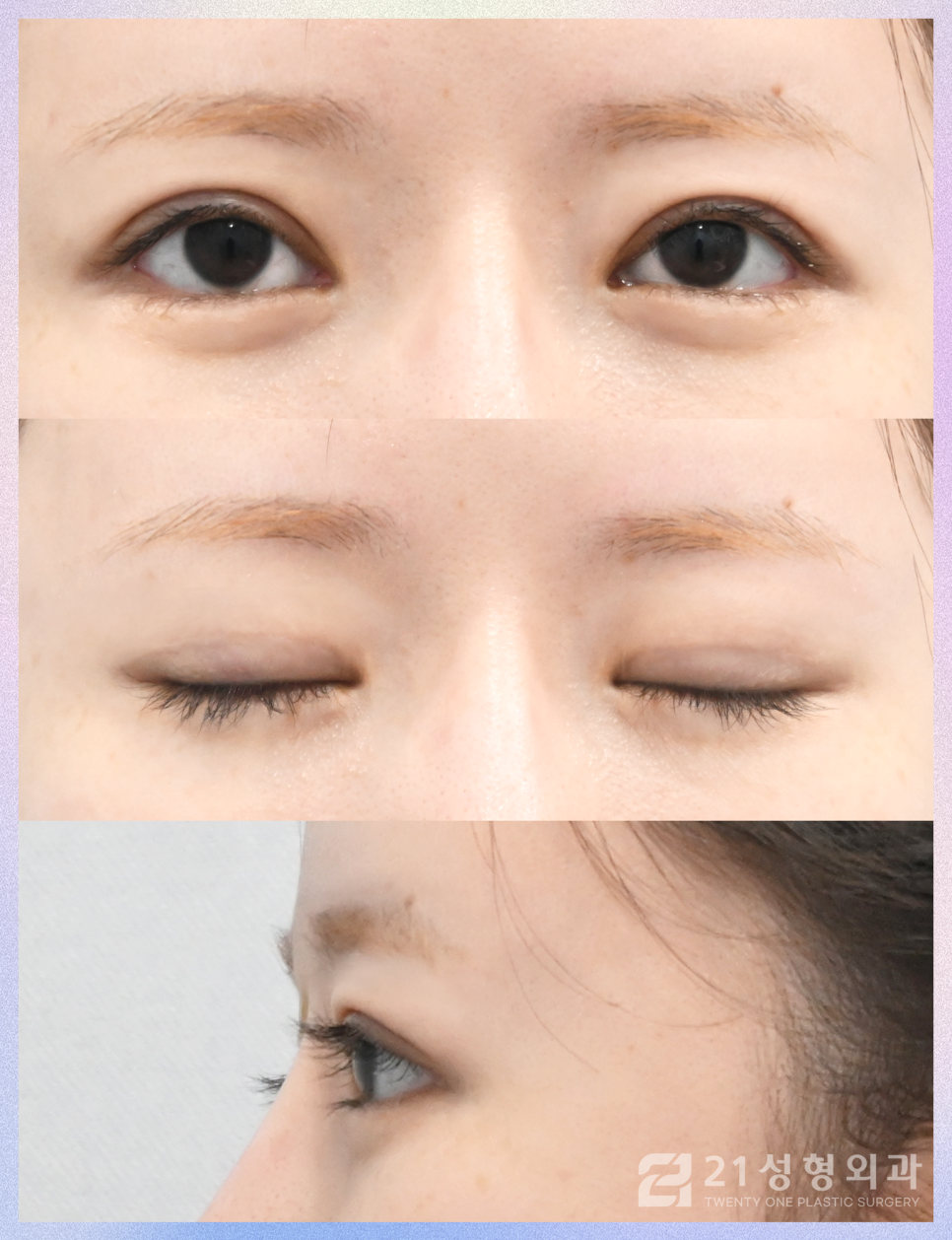 강남역쌍커풀수술 티 나지 않는 자연스러움 관련 이미지 7