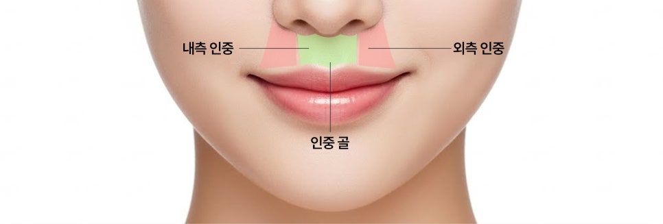 A Lip-Philtrum Reduction Surgery Case: Why Philtrum Dimple Surgery Was Performed Together image 2