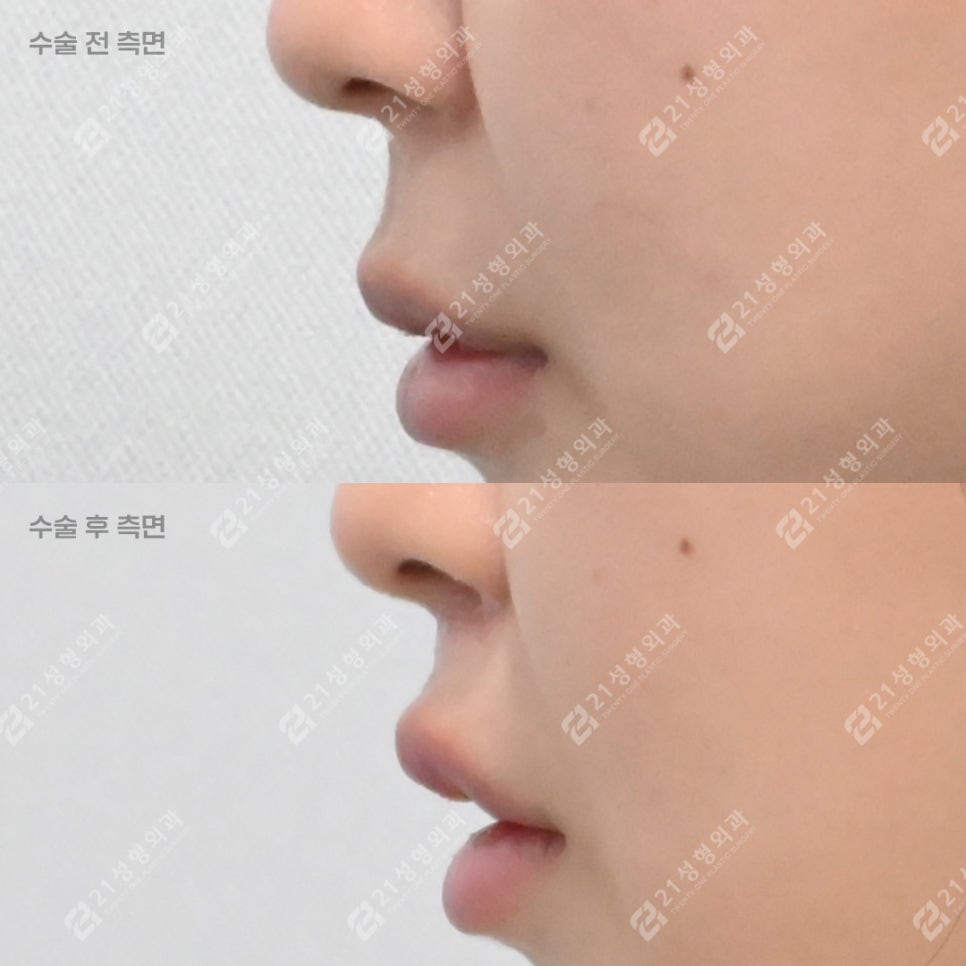 How to Make the Philtrum Look Shorter by Adding Dimension Alongside Philtrum Reduction Surgery image 3