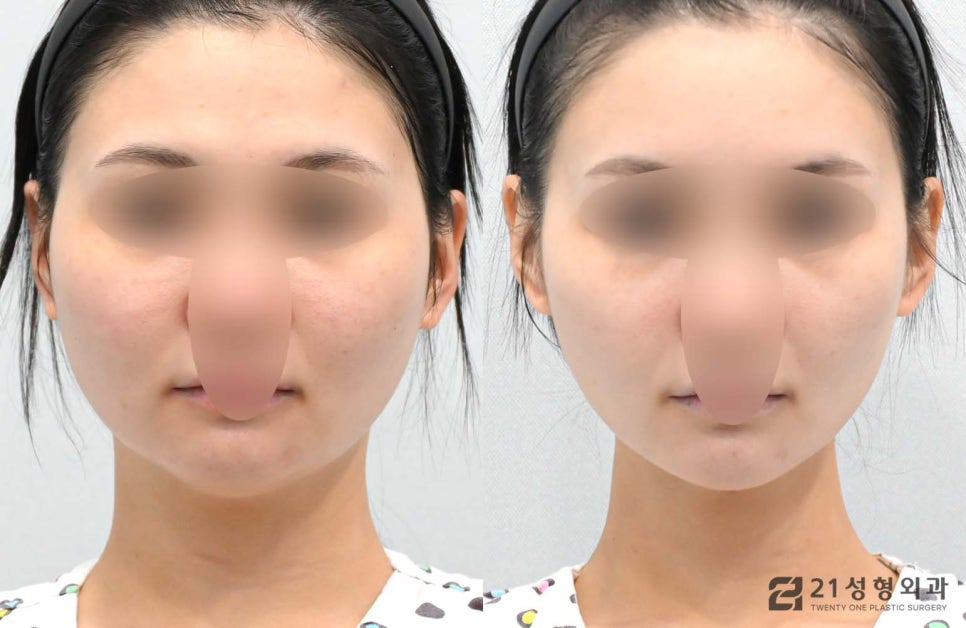 얼굴자가지방이식수술 유지기간과 효과 관련 이미지 1