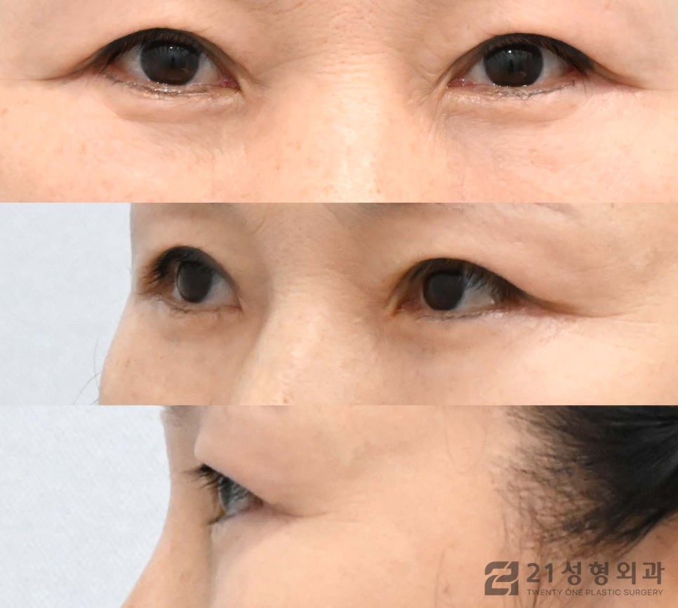 하안검수술잘하는병원 선택 노하우는 관련 이미지 4
