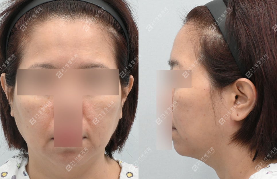 거상 수술의 효과를 극대화하는 방법, 안면목거상 + 근육묶기 케이스 관련 이미지 2