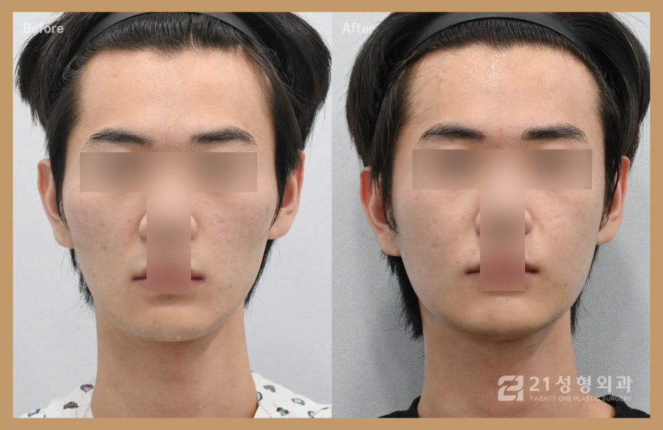 옆광대수술 전 필수로 확인해야 하는 것 관련 이미지 1