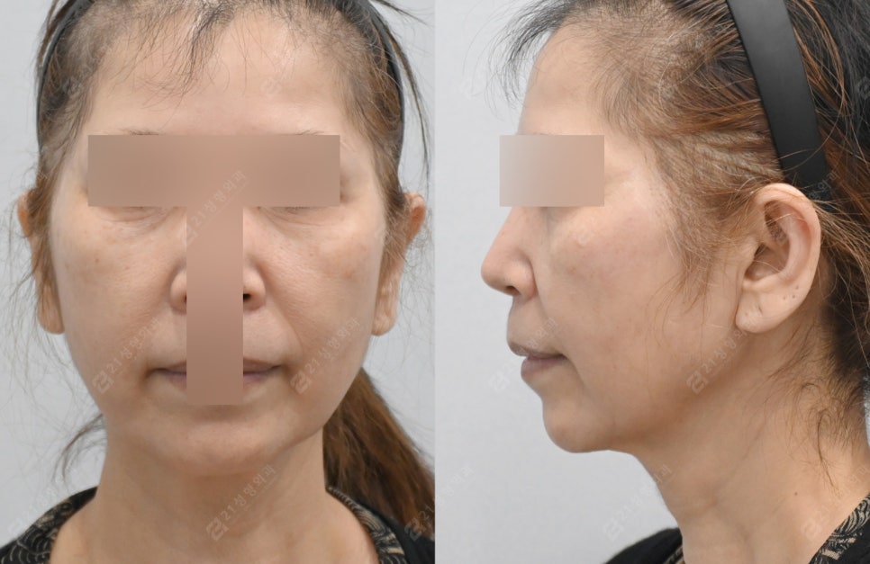 Facelift Surgery Without a Pulled Earlobe: A Real Patient Review image 4