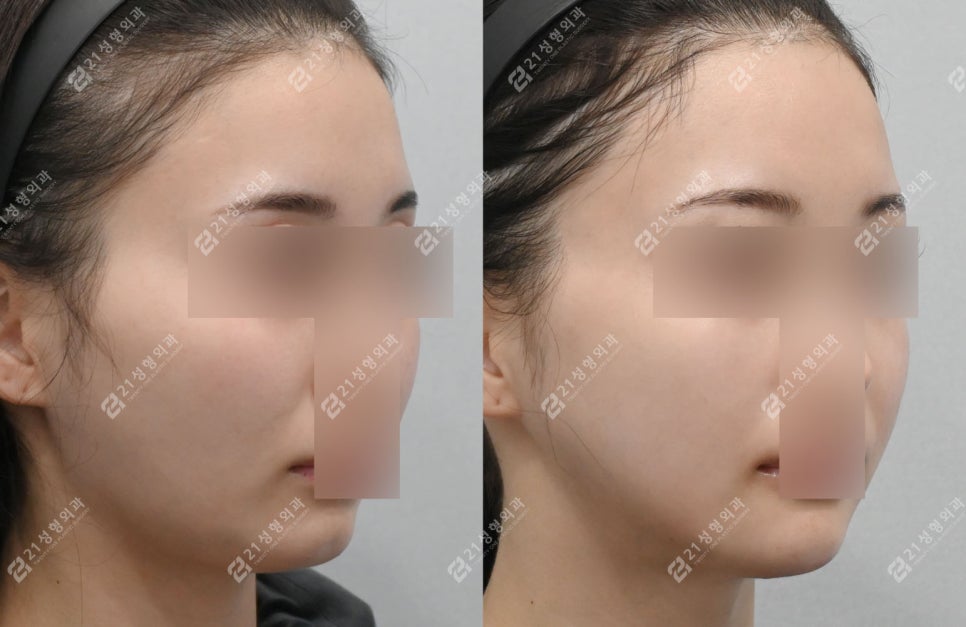 작은 얼굴이지만 윤곽 3종이 필요한 케이스: 턱끝 전진형 얼굴 분석 관련 이미지 6