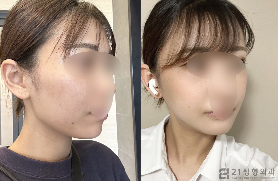 안면 윤곽 수술 잘하는 곳 신중하게 찾아보자 관련 이미지 2