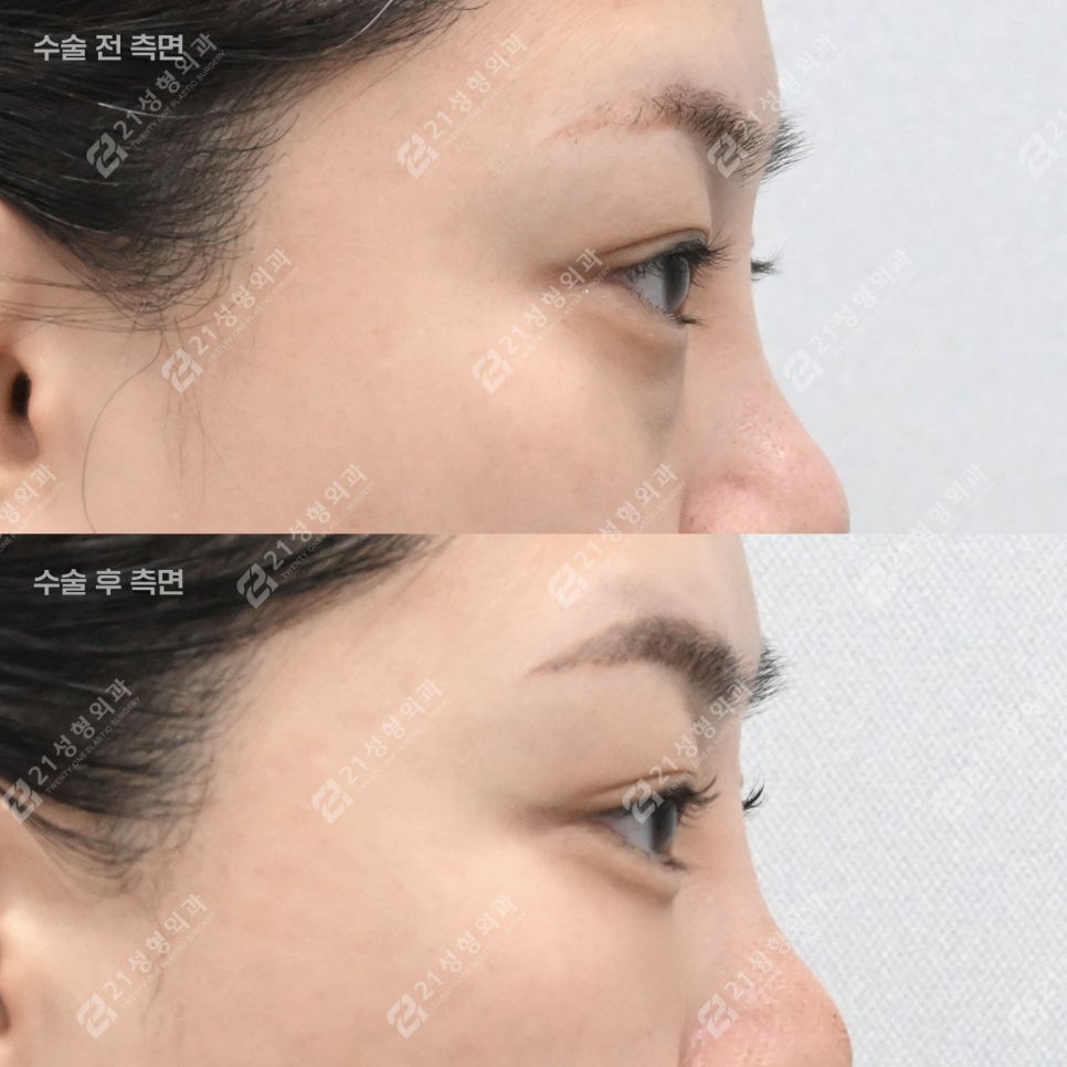 Can Tired Eyes Be Changed? A Real Review of Under-Eye Fat Repositioning for a Woman in Her Late 30s! image 4