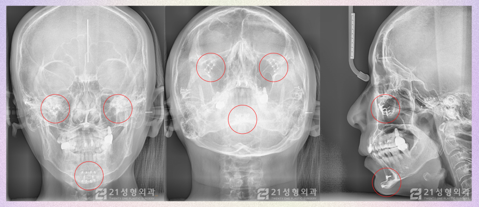 강남안면윤곽핀제거 수술 시기는? 관련 이미지 4