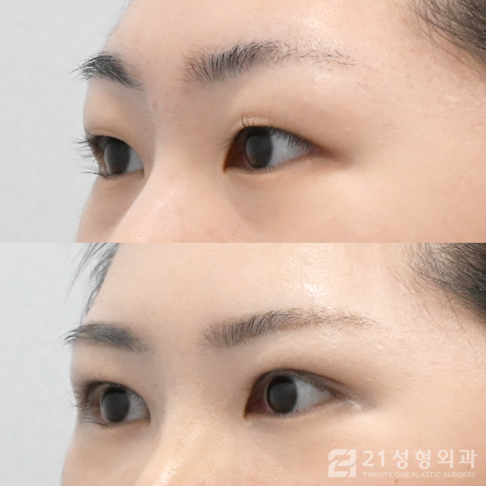 눈매교정병원 자연스러운 눈의 차이 관련 이미지 2