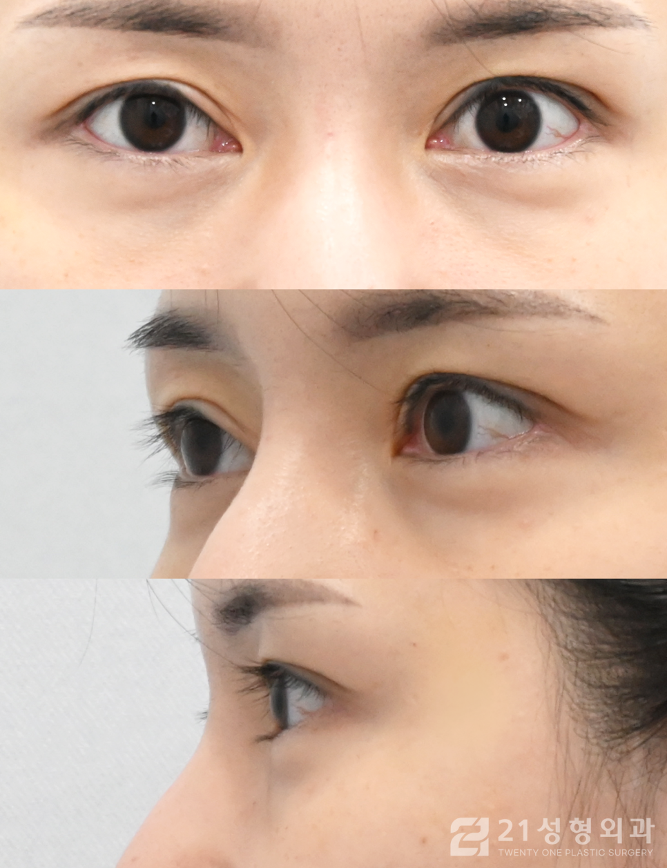 눈밑지방재배치수술병원 확실한 효과는 관련 이미지 4
