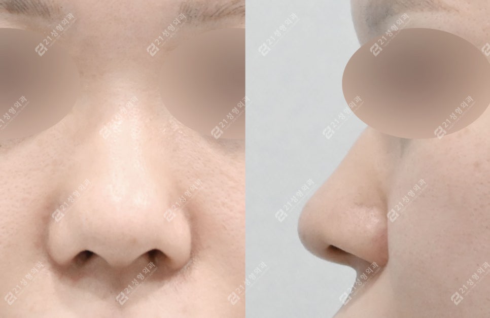 How to Create a Flawless Nose Line | Real Review of Rib Cartilage Rhinoplasty image 2